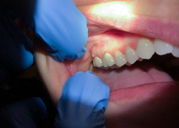 Best Emergency Treatment for Dental Infections or Abscesses in Boerne, TX